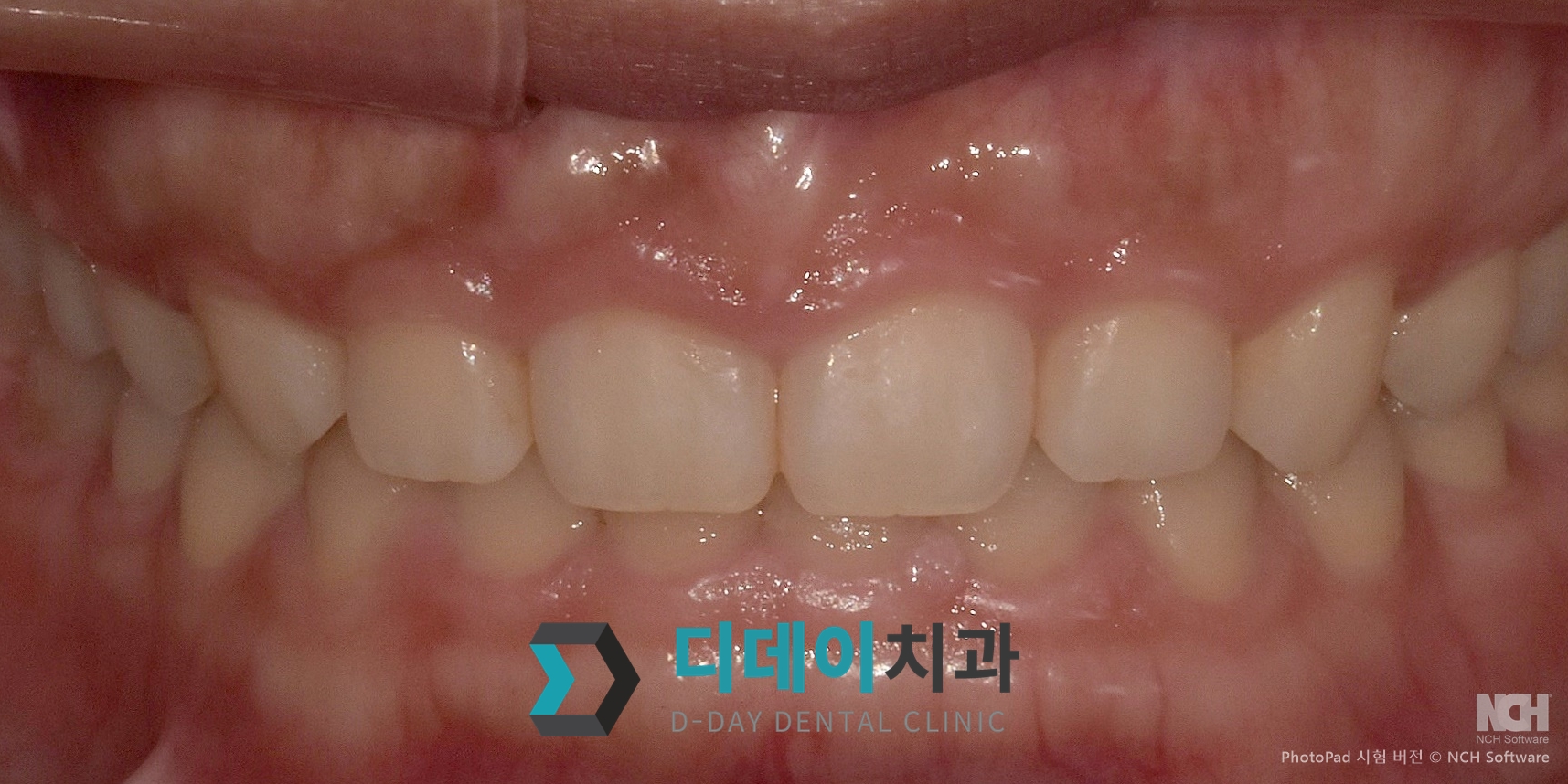 잇몸 성형 치료 전