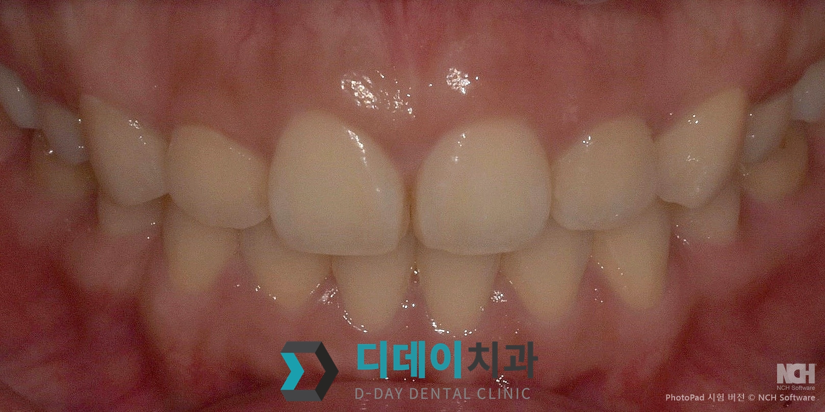 잇몸 성형 치료 전
