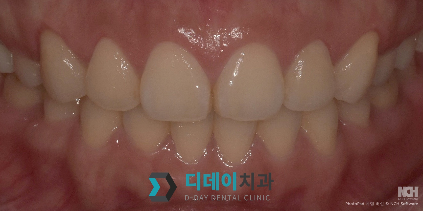 잇몸 성형 치료 후