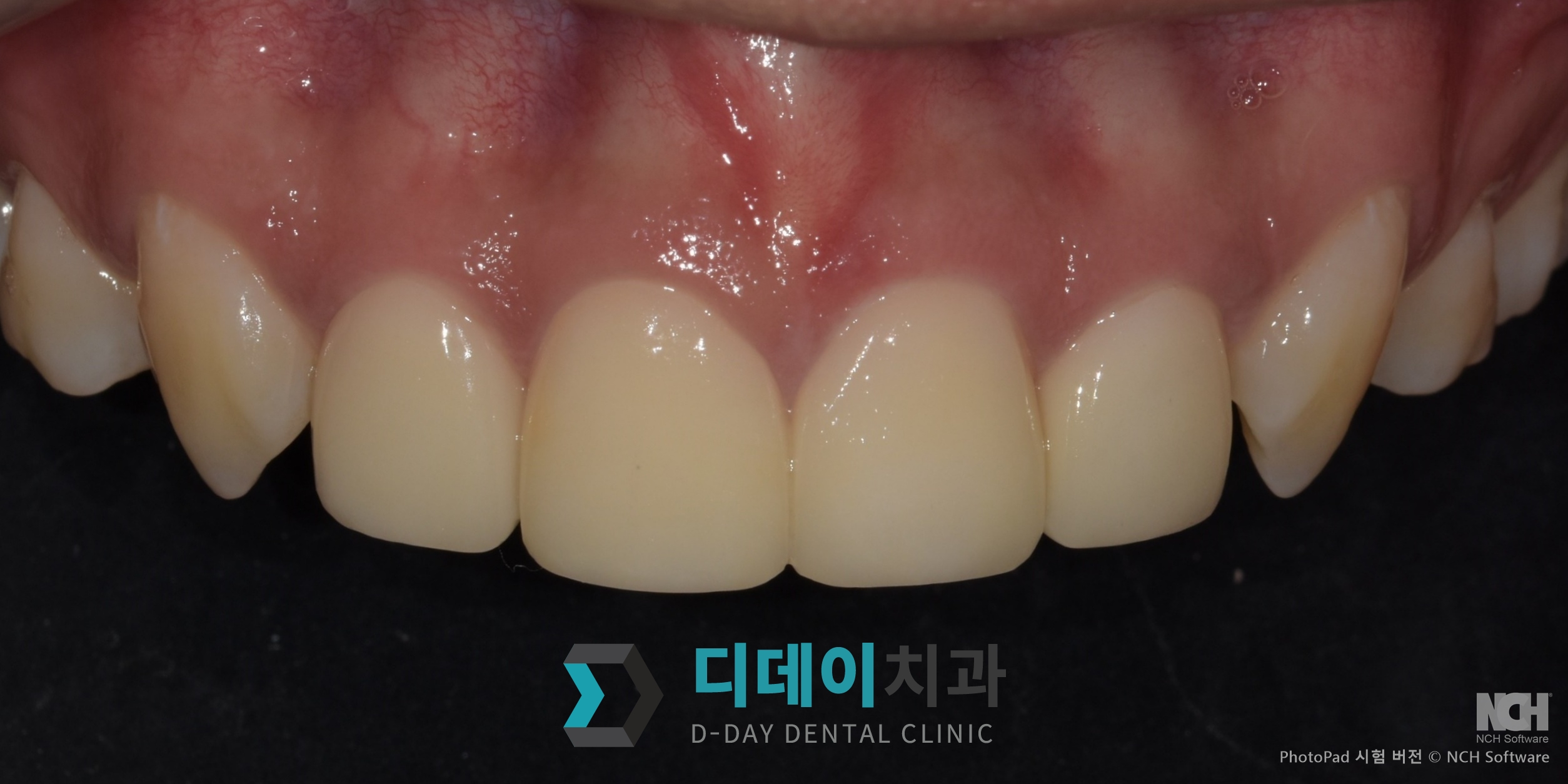 라미네이트 치료 후