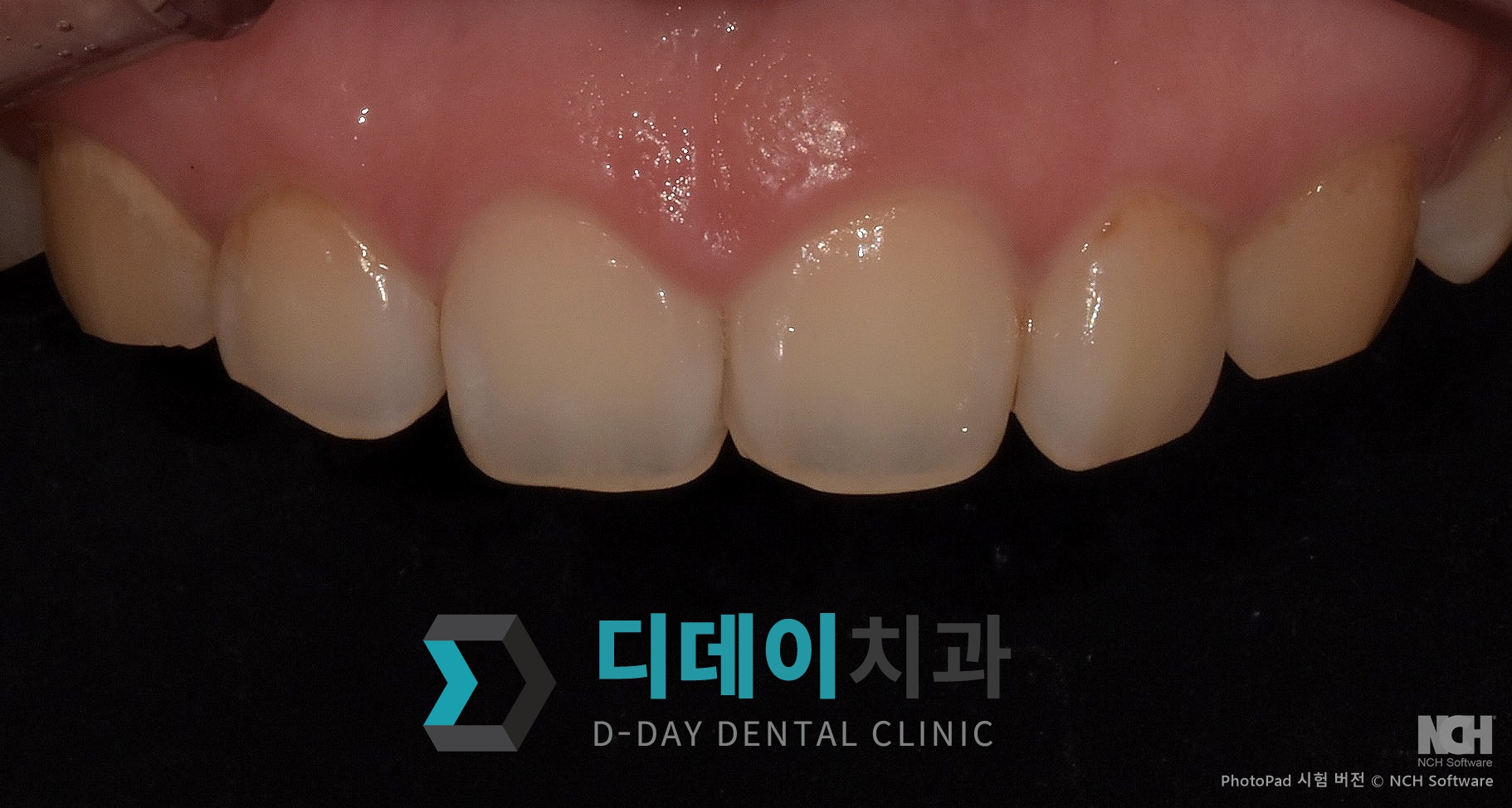잇몸성형 치료 전