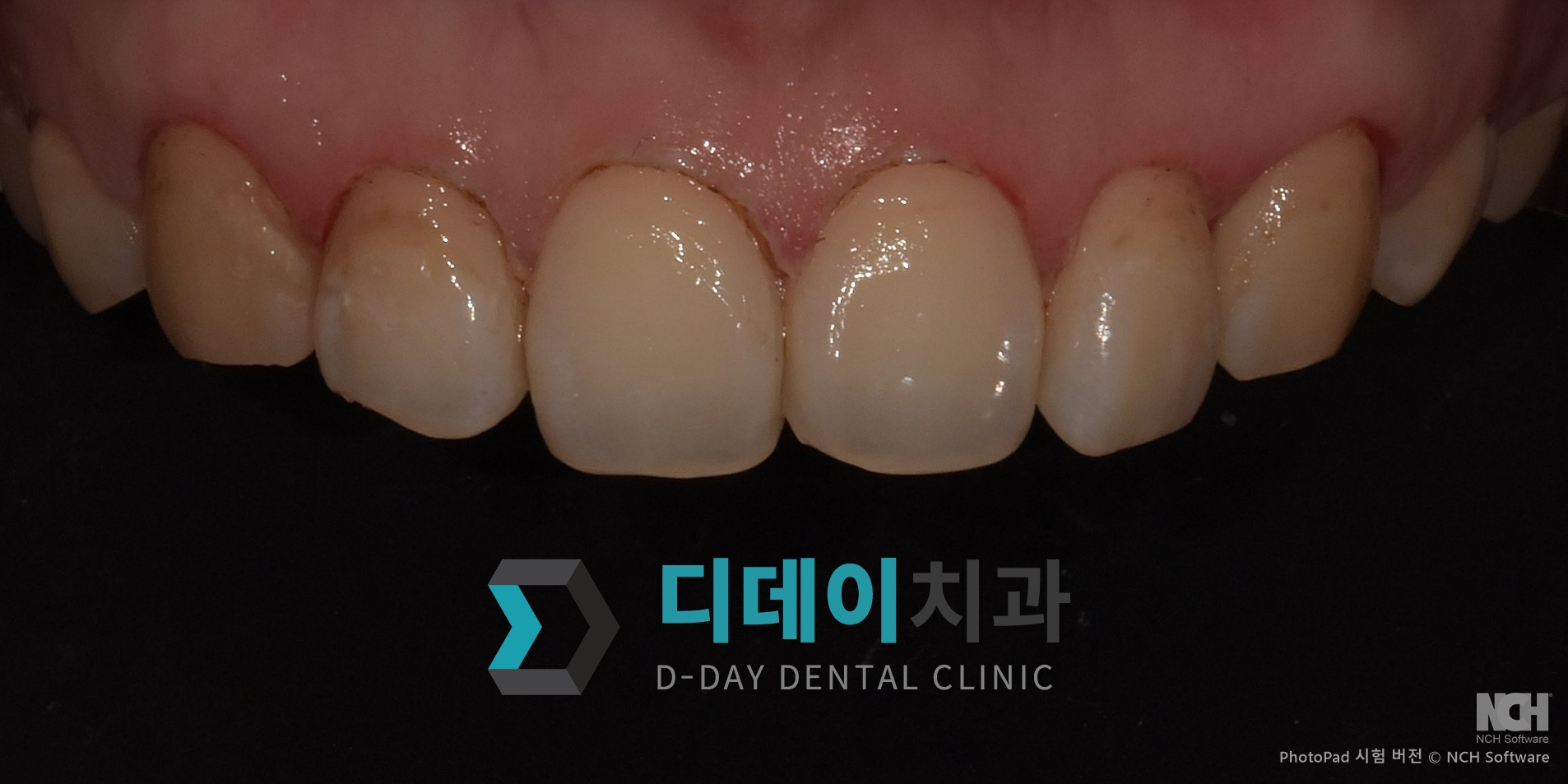 잇몸성형 치료 후