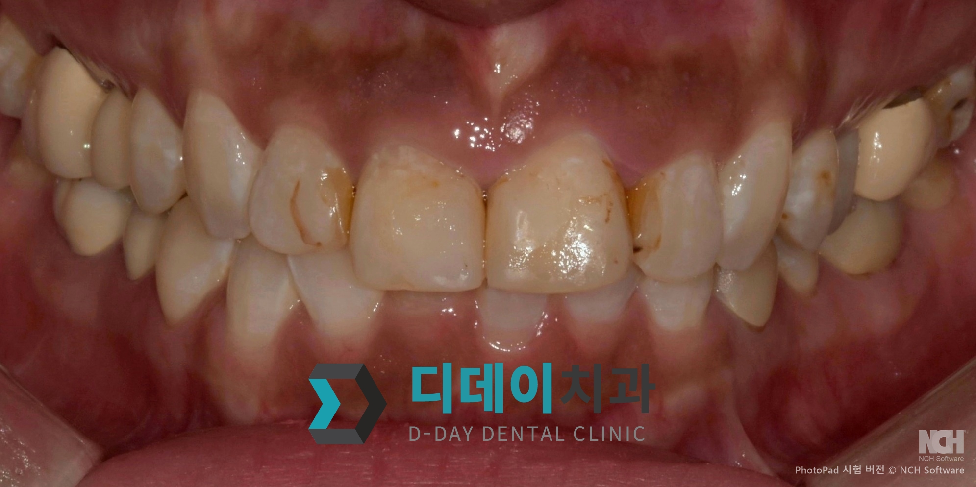 라미네이트 치료 전