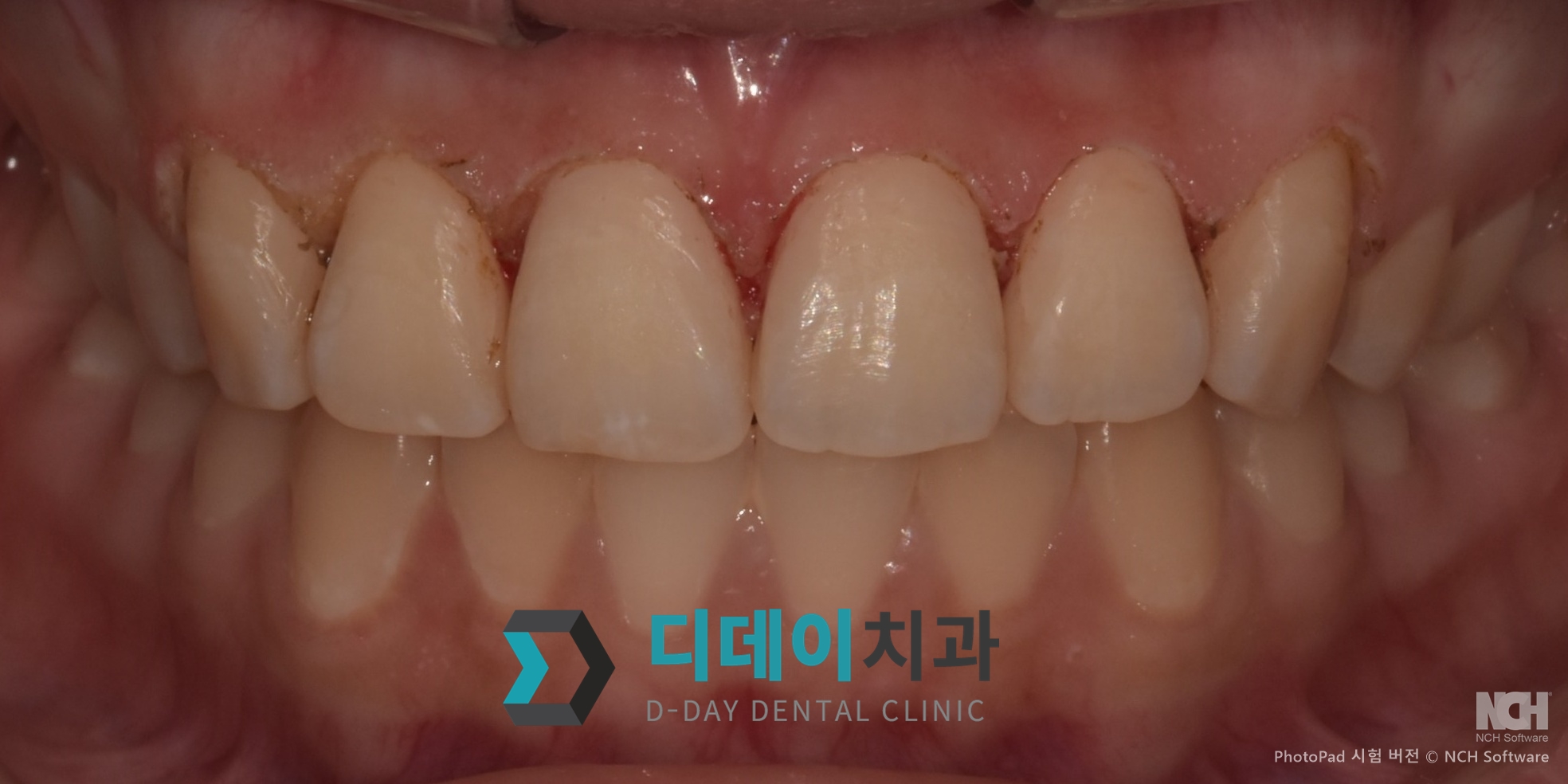 잇몸성형 치료 후
