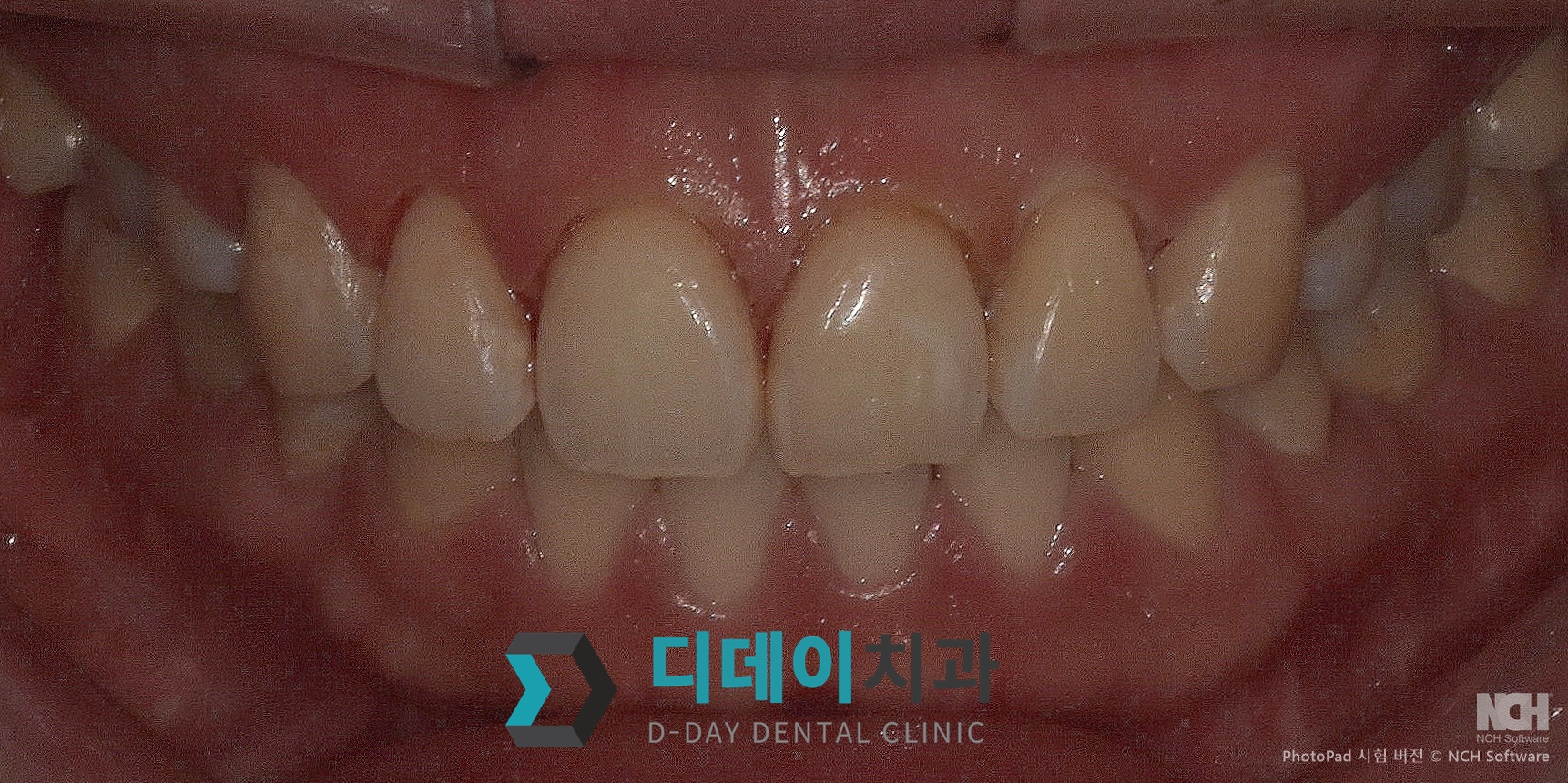 잇몸성형 치료 후