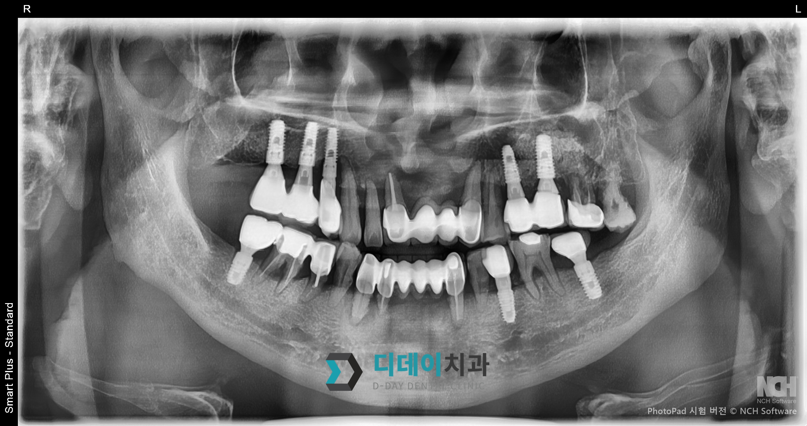 임플란트 (발치 후 즉시식립) 치료 전