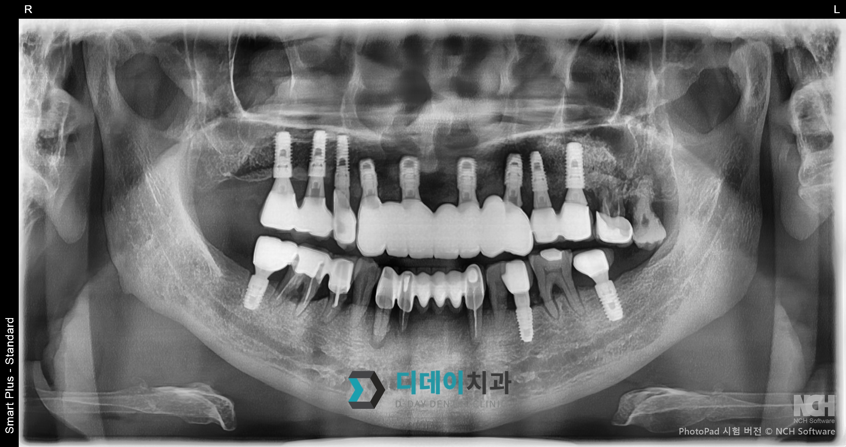 임플란트 (발치 후 즉시식립) 치료 후