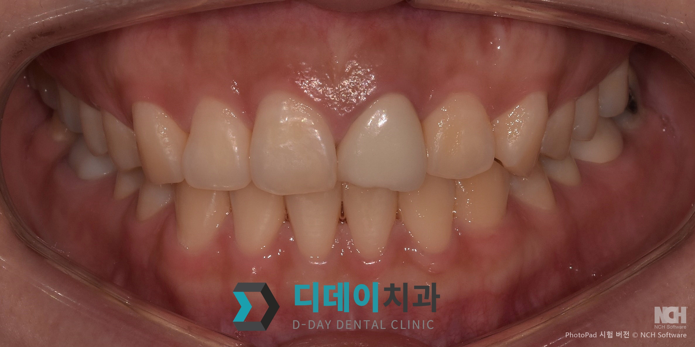 라미네이트 재시술 치료 전