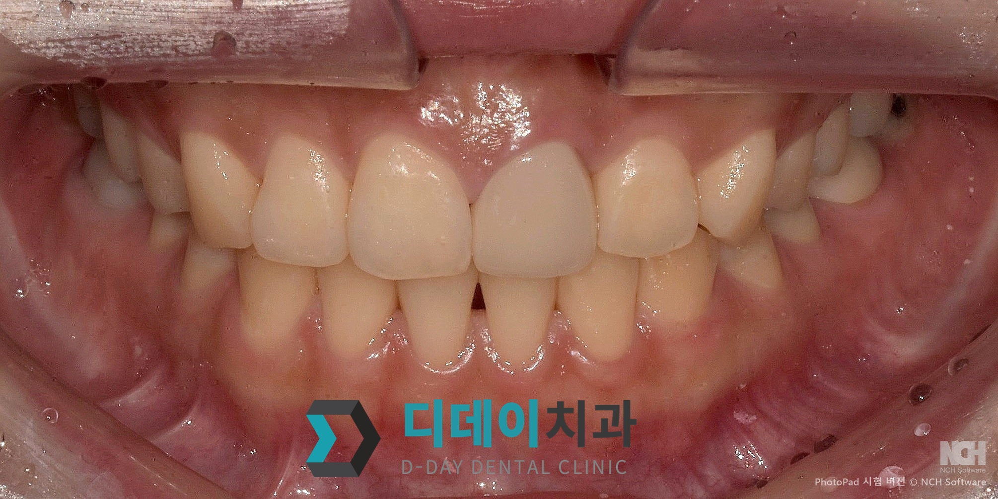 라미네이트 재시술 치료 후