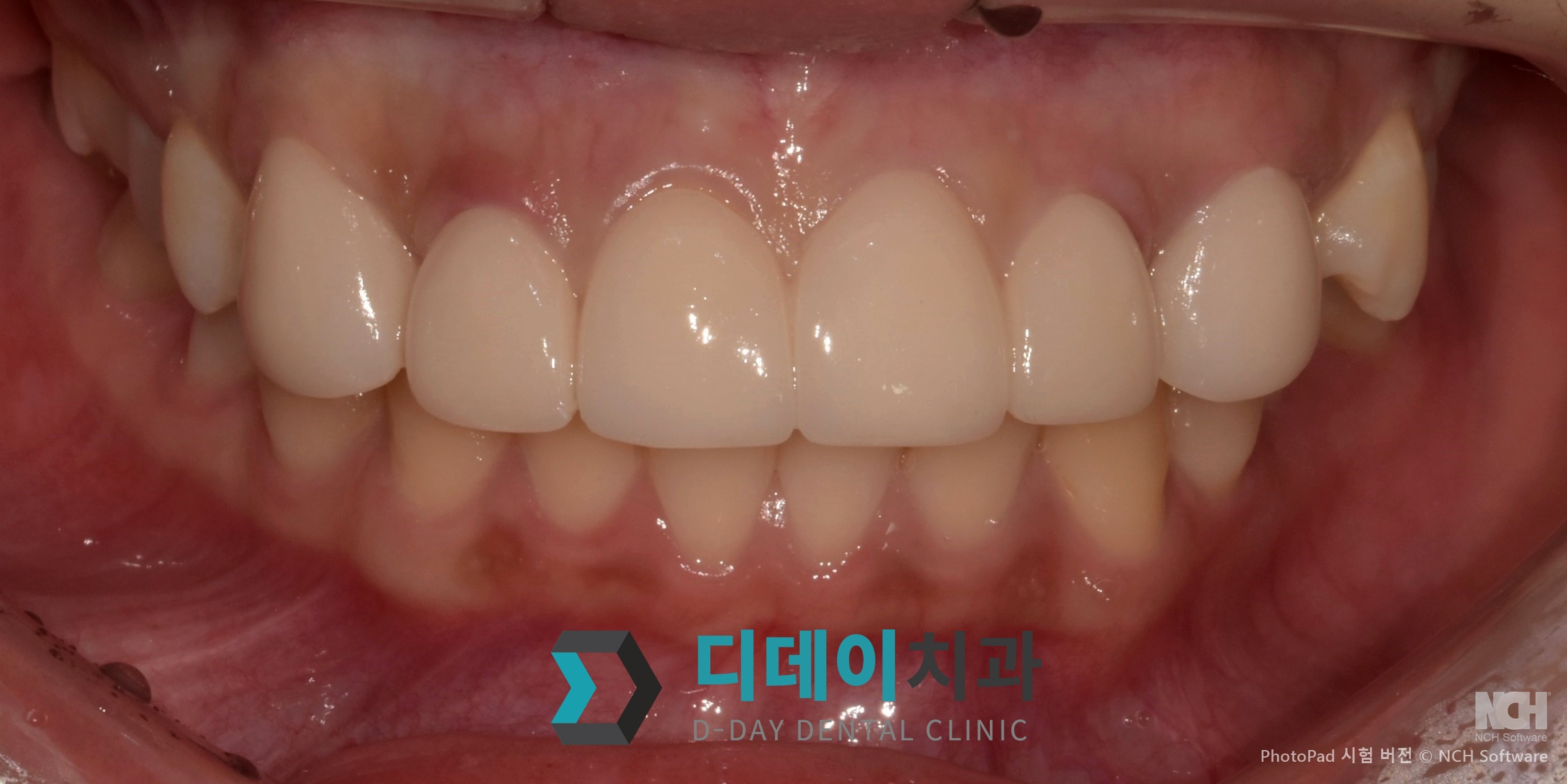 라미네이트 치료 후