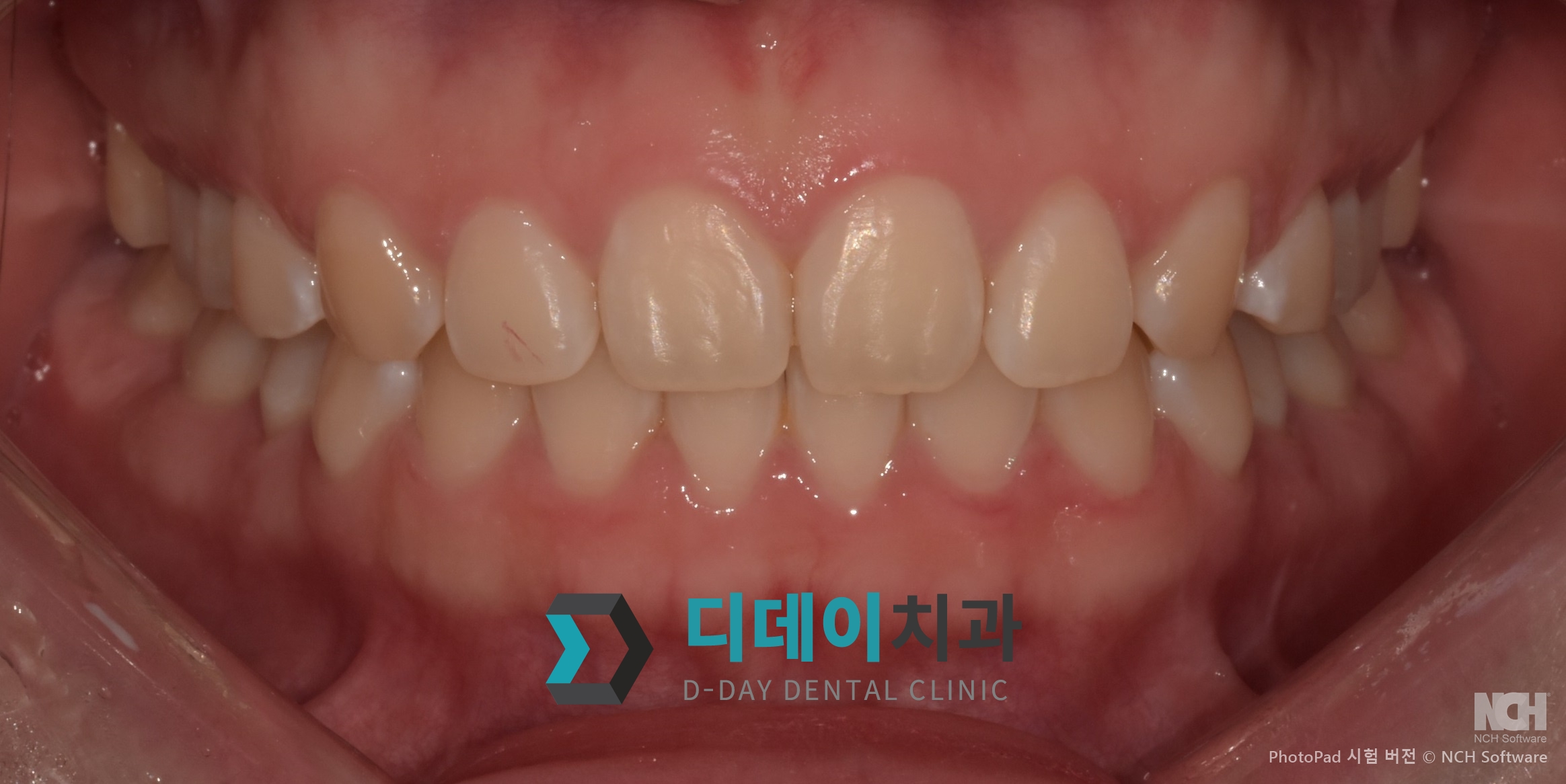 잇몸성형 치료 전