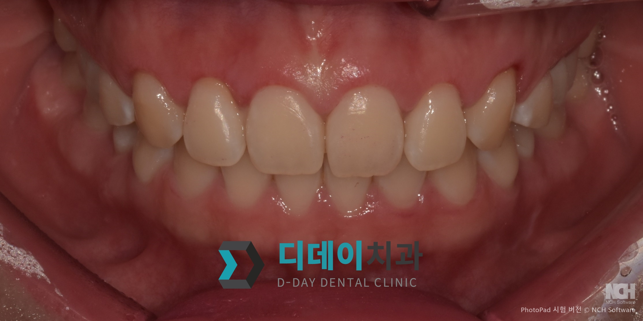 잇몸성형 치료 후