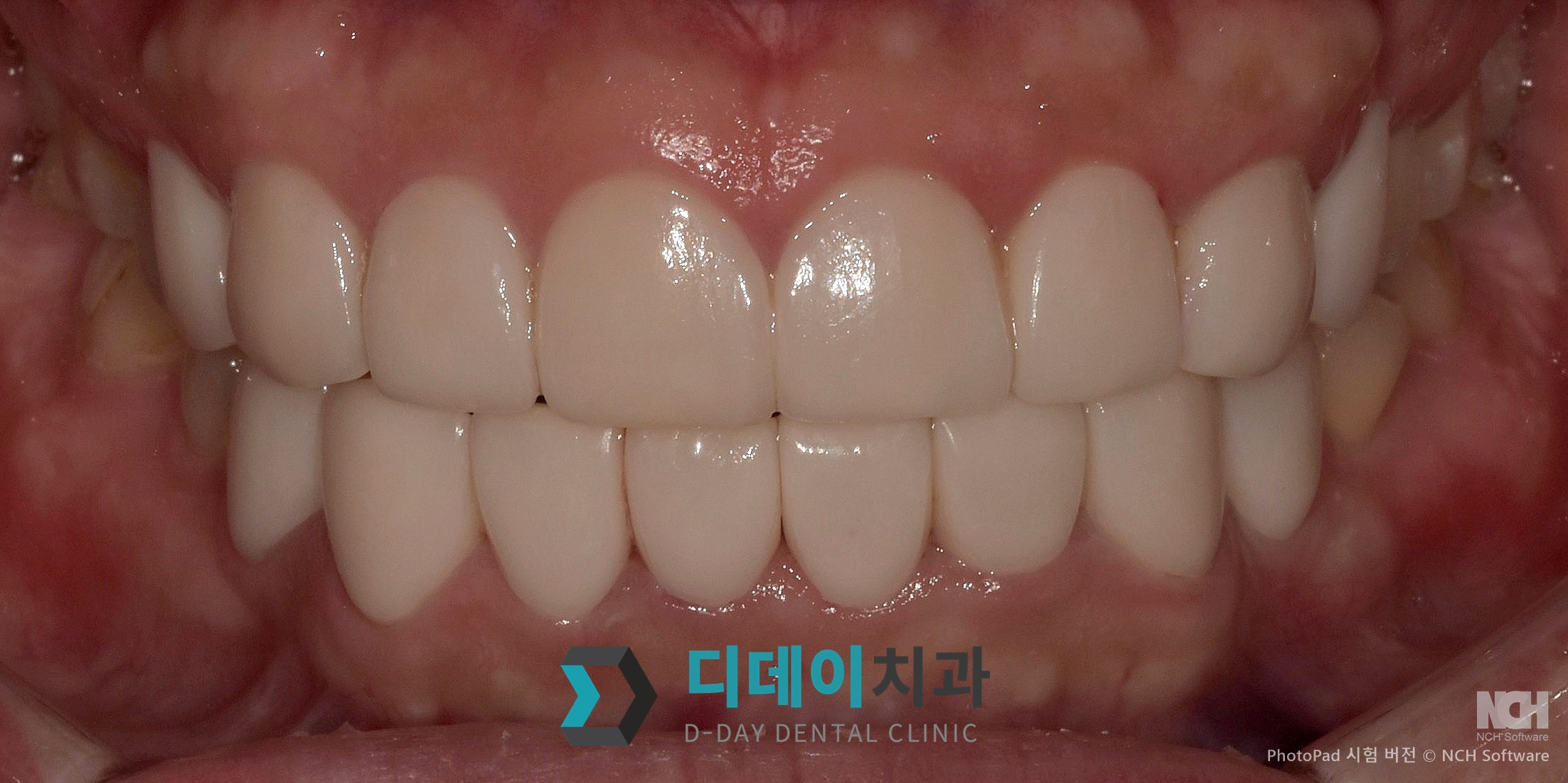 라미네이트 치료 후