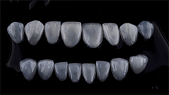 e.max 보철물