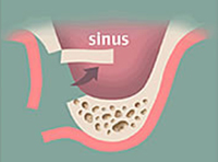 Sinus Lift 술식 1