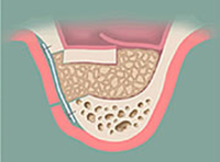 Sinus Lift 술식 2
