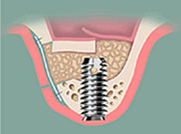 Sinus Lift 술식 3